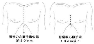低侵襲心臓手術