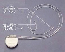 ペースメーカーの植込み方法