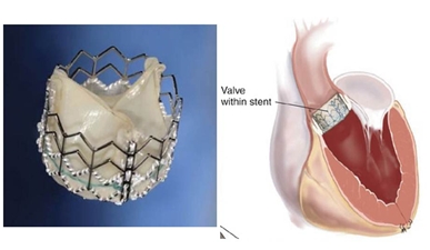 経カテーテル大動脈弁留置術(TAVI)とは?